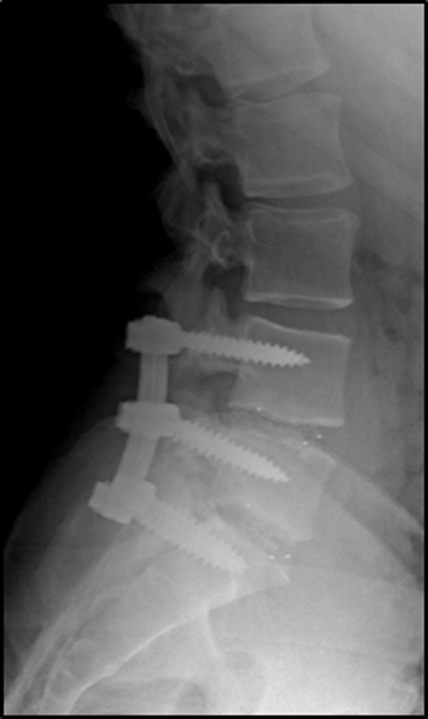 Spinal Reconstruction and Fusion_2